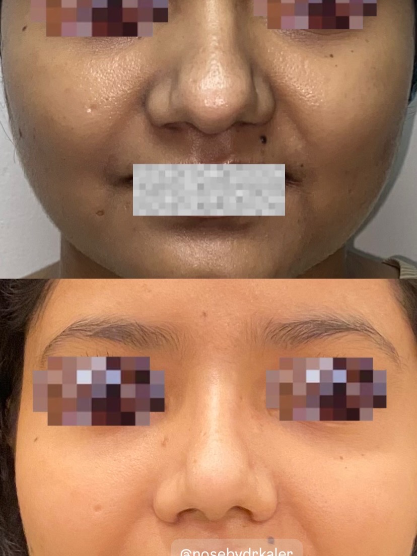 Indian Nose Rhinoplasty