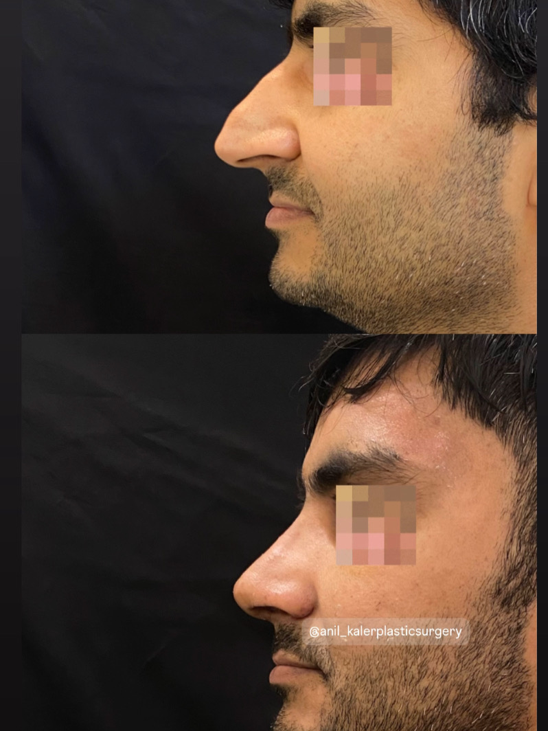 Big nose with moderate skin