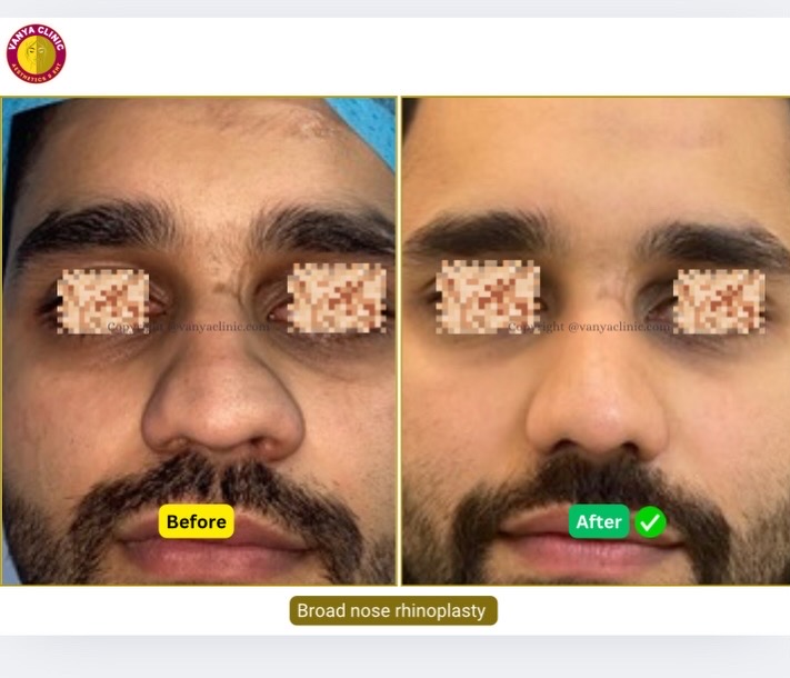 Big nose, thick skin