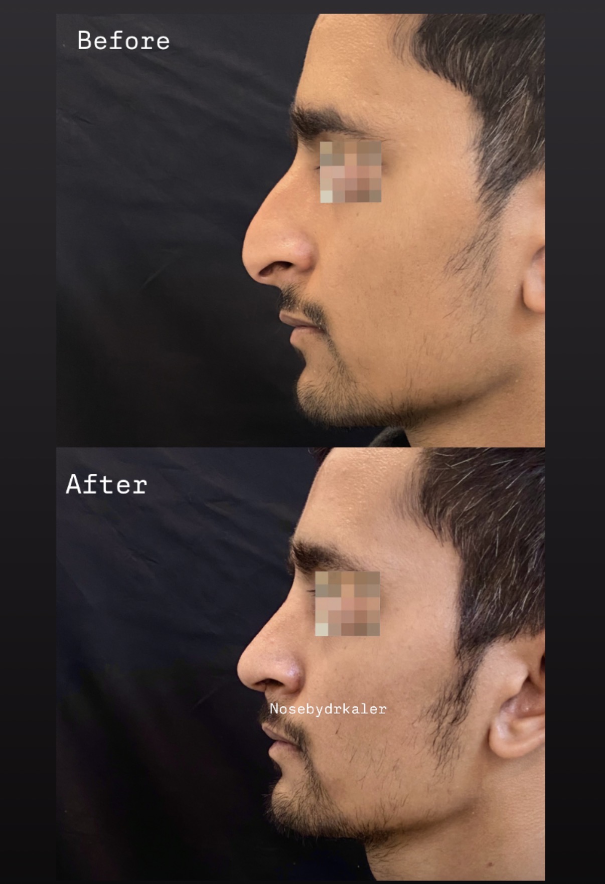 Dorsal hump removal by total dorsal preservation