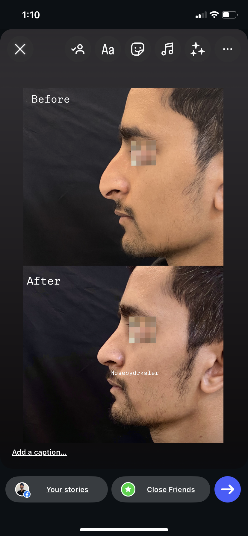 Preservation rhinoplasty in a big hump but thin skin