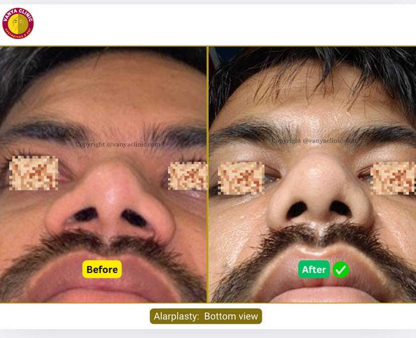 Thick skin, wide ala