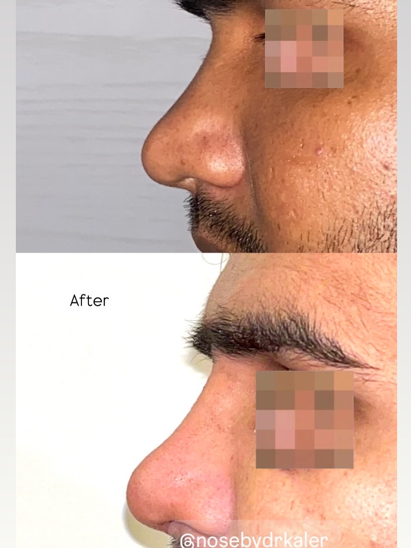 Low dorsal bridge, augmentation done with costal cartilage