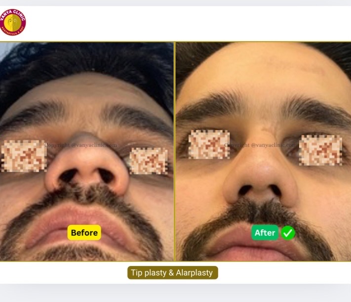 Big nose with weak cartilage