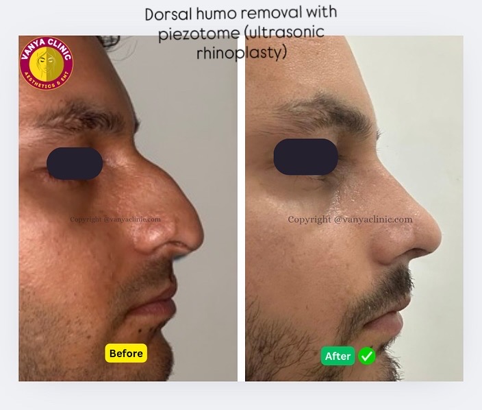 Dorsal hump with thin skin