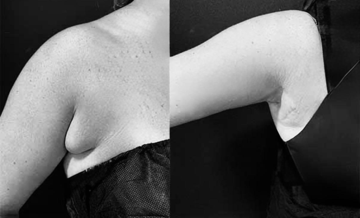 before and after  ( combination approach)