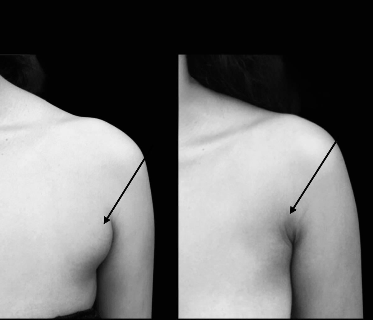 Underarm Fat Liposuction