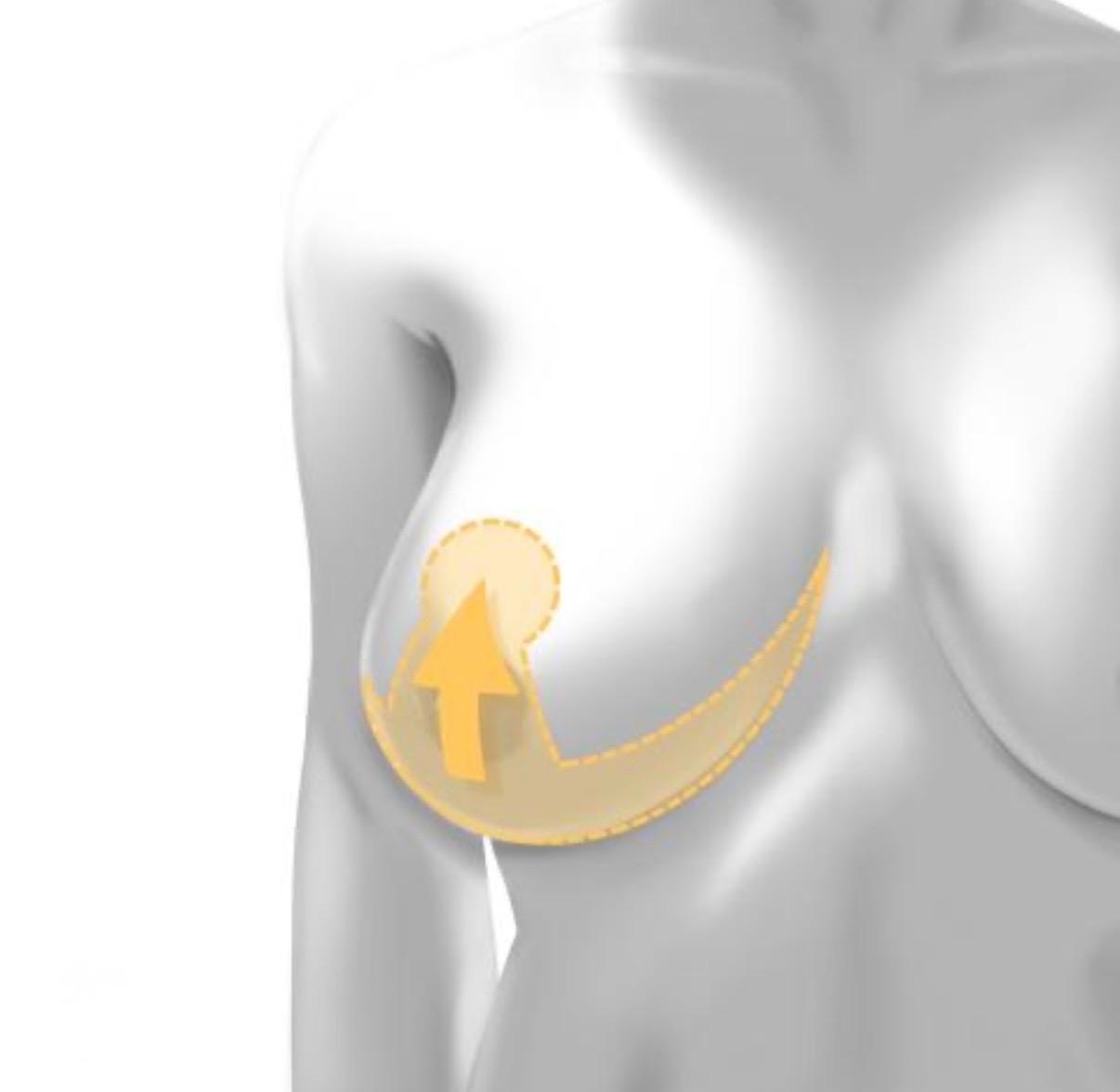 Reduction mammoplasty using the Inverted -T (Wise pattern) Technique