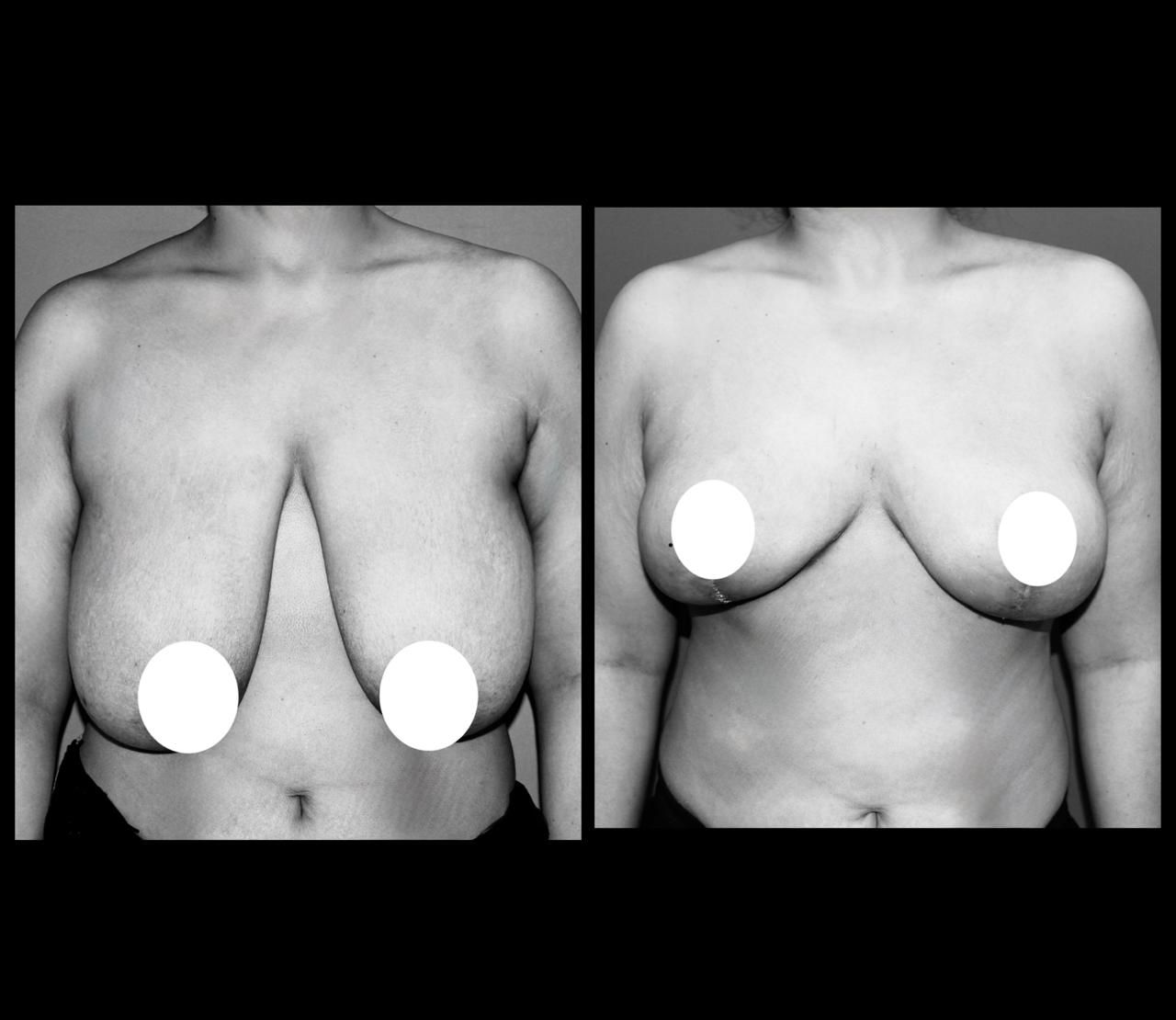 Pre and Post breast reduction surgery 
