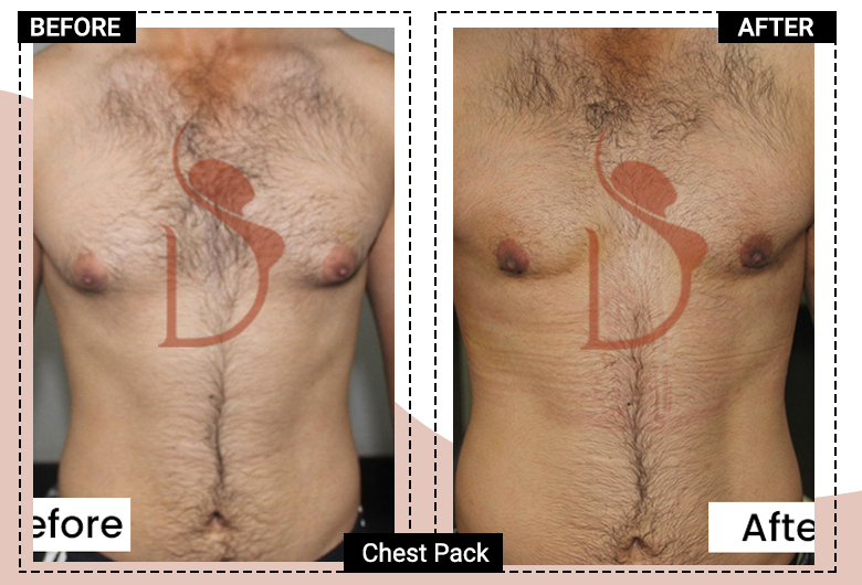 6 Pack Abs Surgery in India
