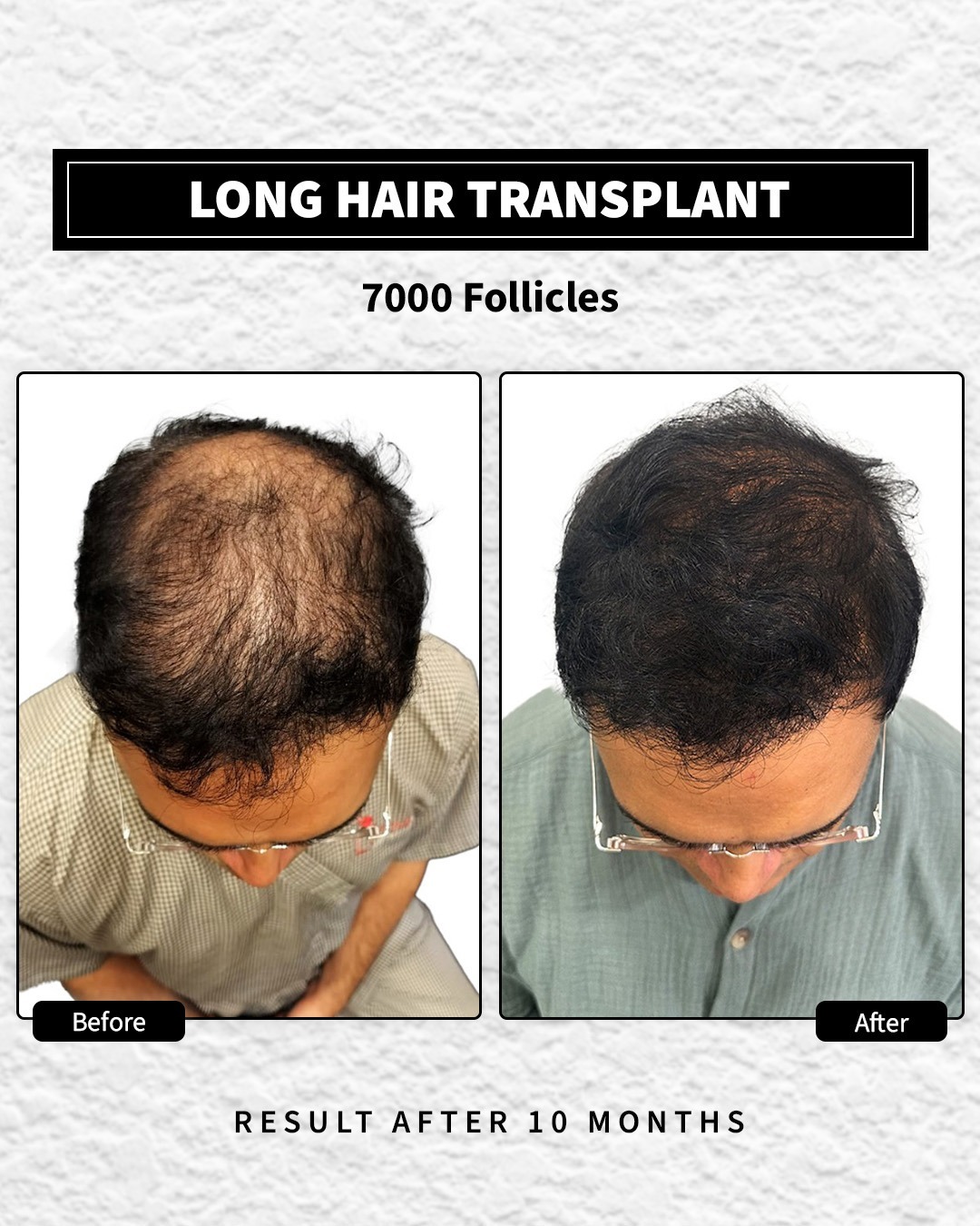 Long Hair Transplant done with 7000 follicles. The after image is 10 months after procedure