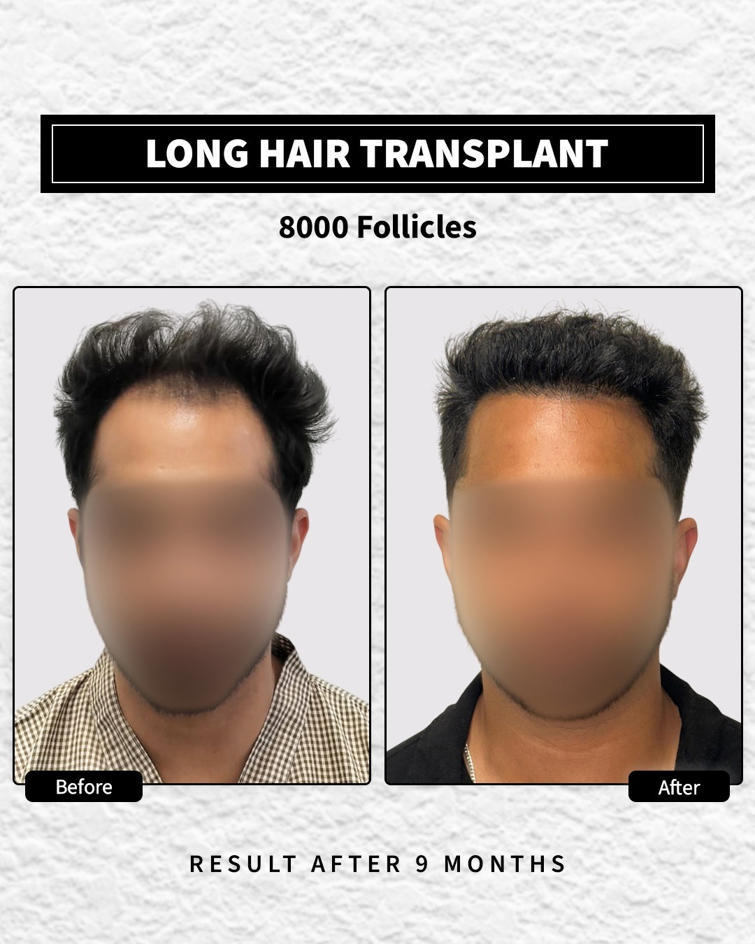 Long Hair Transplant done with 8000 follicles. The after image is 9 months after procedure