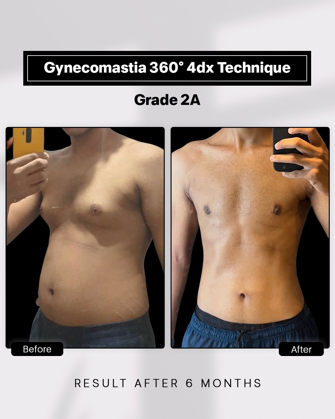 Before and After image for Gynecomastia Grade 2A