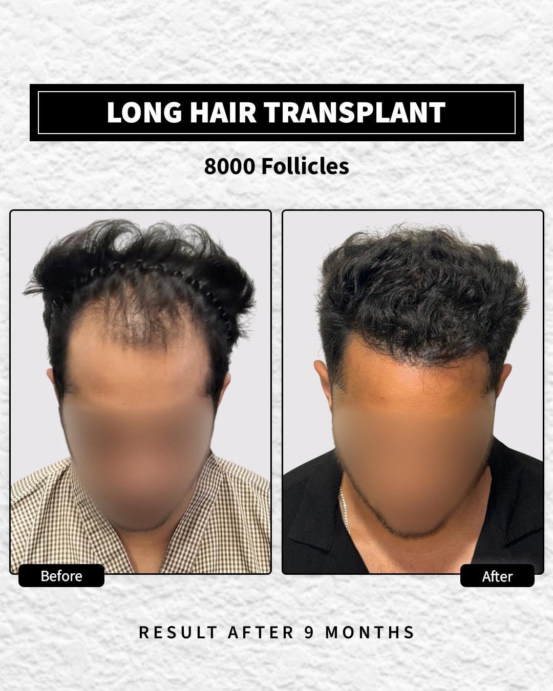 Long Hair Transplant done with 8000 follicles. The after image is 9 months after procedure
