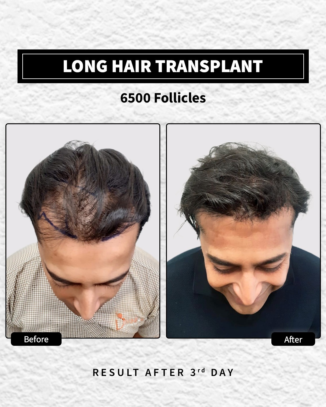 Long Hair Transplant done with 6500 follicles. The after image is 3rd day after procedure