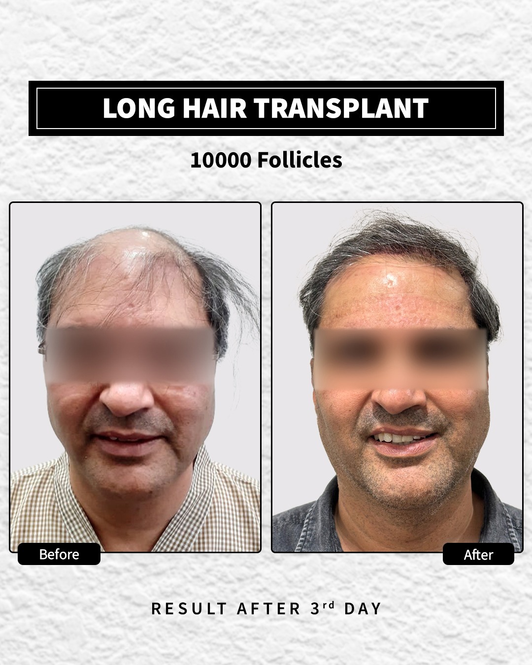 Long Hair Transplant done with 10000 follicles. The after image is 3rd day after procedure