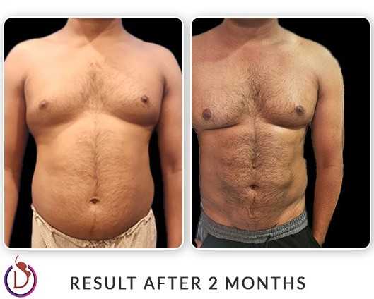 6 Pack Abs surgery Before & After Image