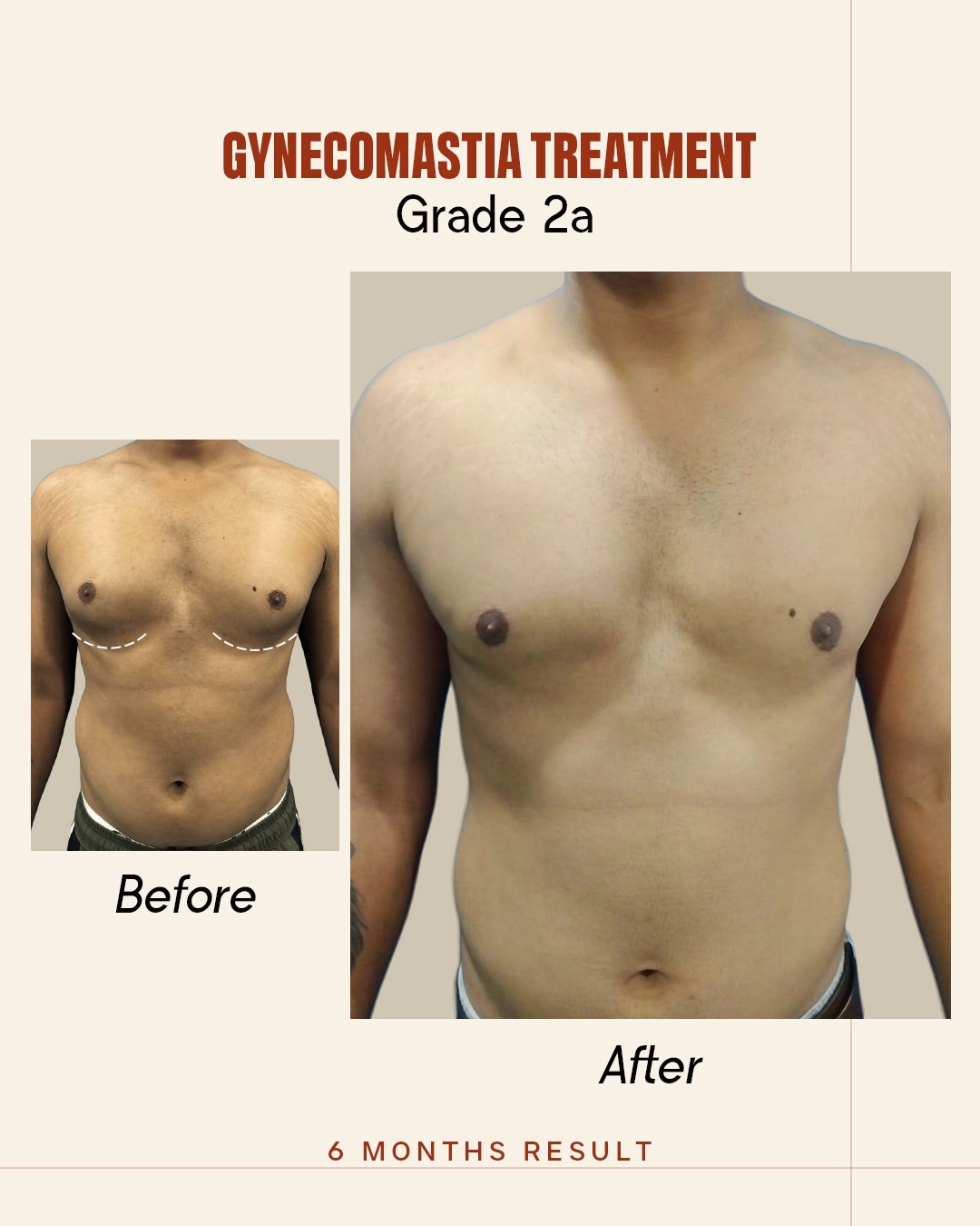 Before and After image for Gynecomastia Grade 2A