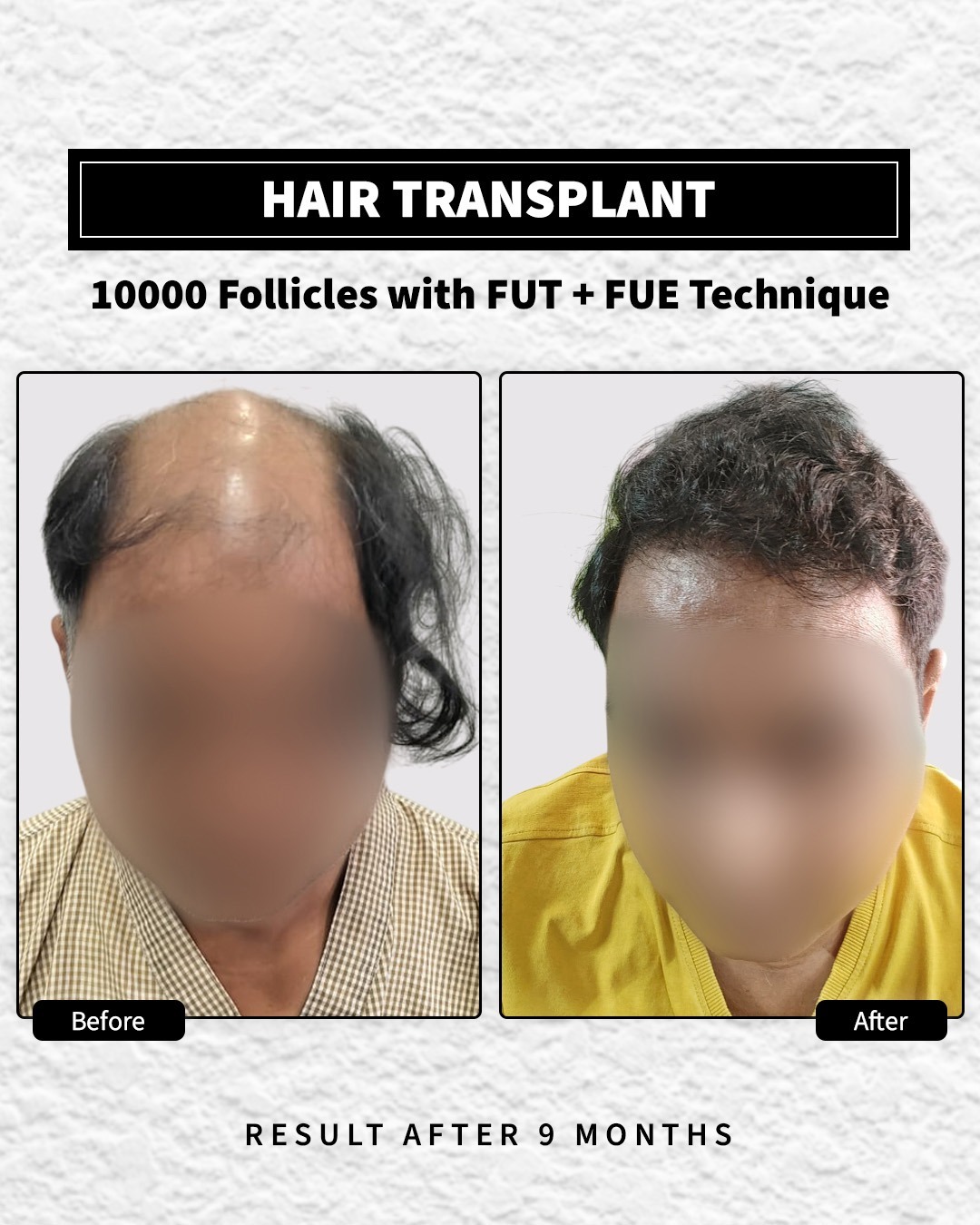 Long Hair Transplant done with 10000 follicles. The after image is 9 months after procedure