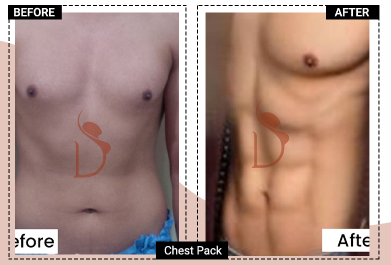 6 Pack Abs surgery Before & After Image