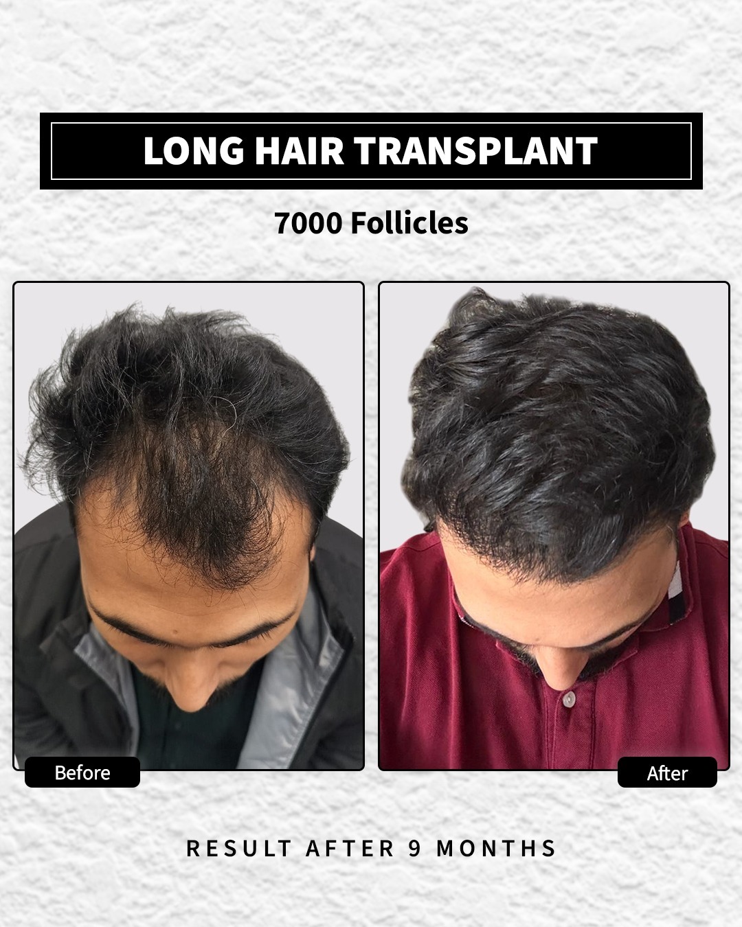Long Hair Transplant done with 7000 follicles. The after image is 9 months after procedure