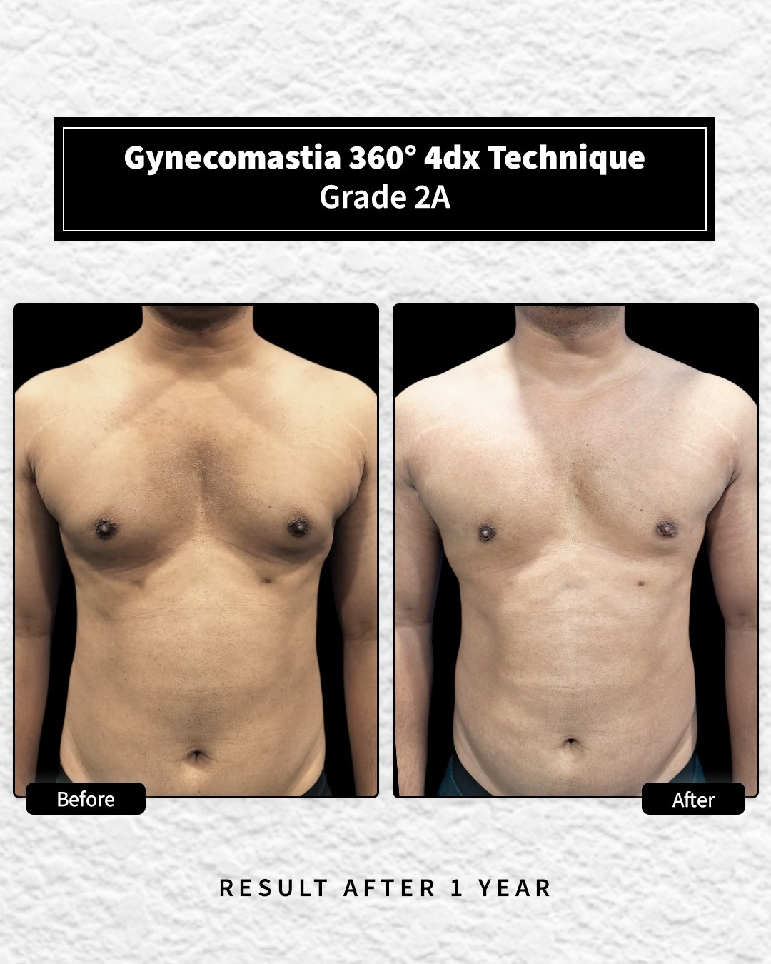 Before and After image for Gynecomastia Grade 2A