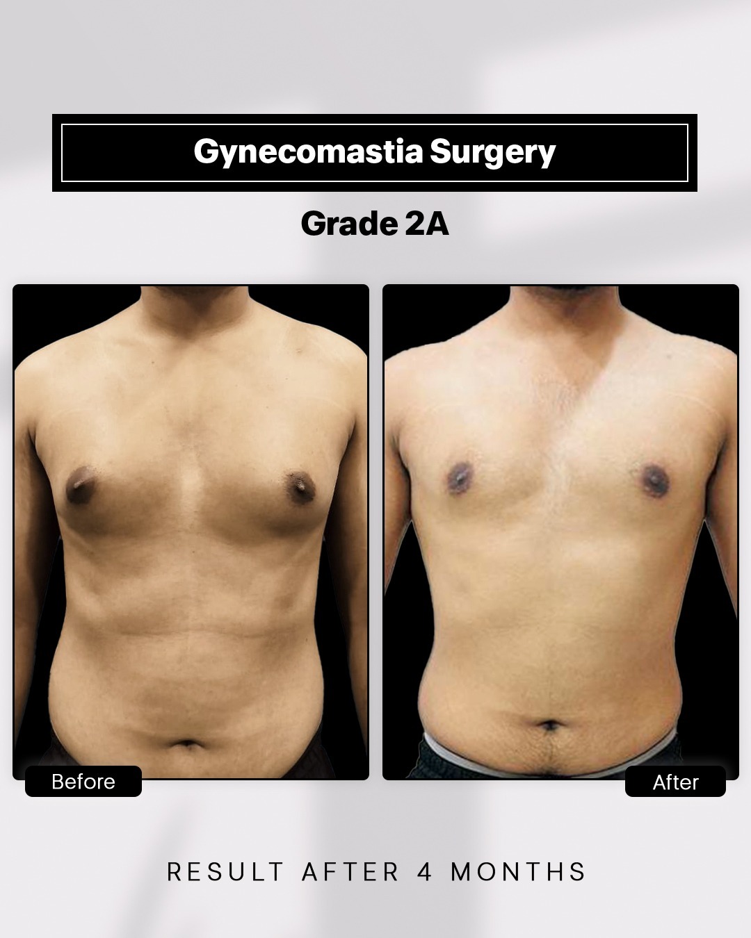 Before and After image for Gynecomastia Grade 2A