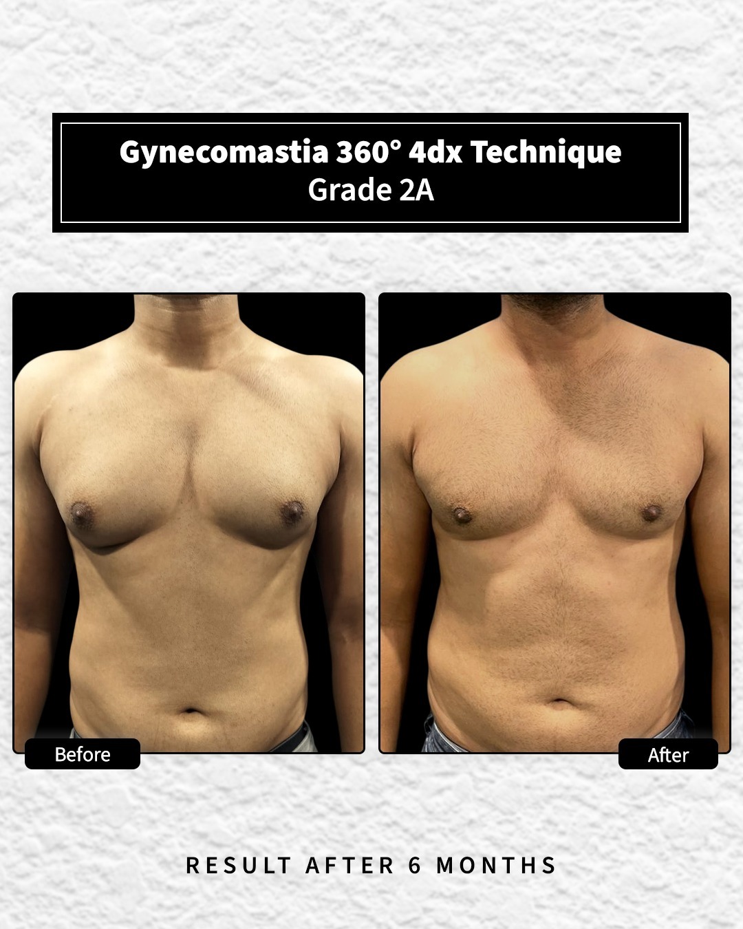 Before and After image for Gynecomastia Grade 2A