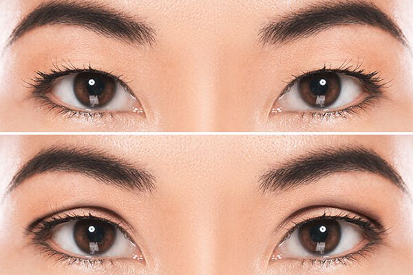 Double Eyelid Surgery