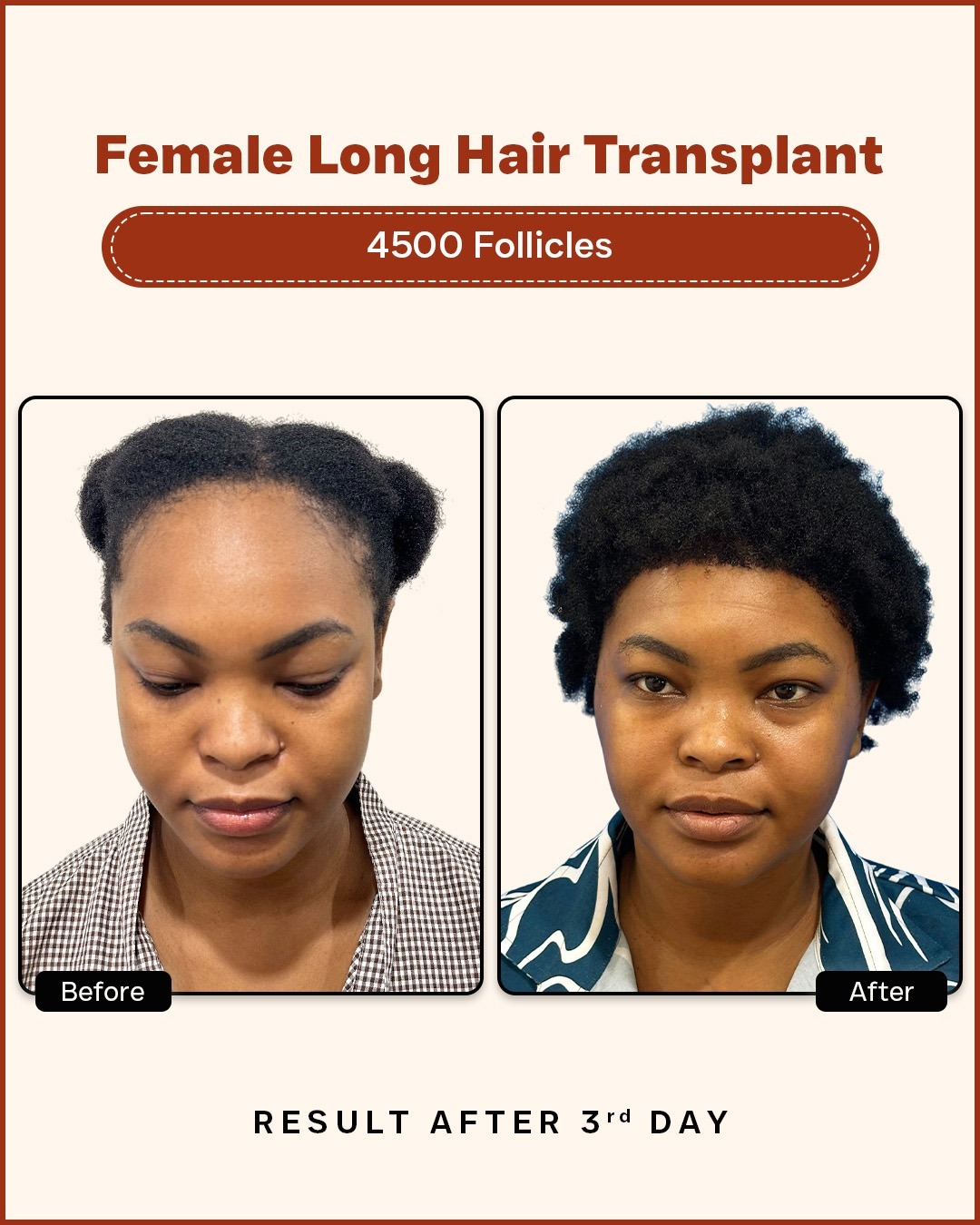 Long Hair Transplant done in Female with 4500 follicles. The after image is 3rd day after procedure