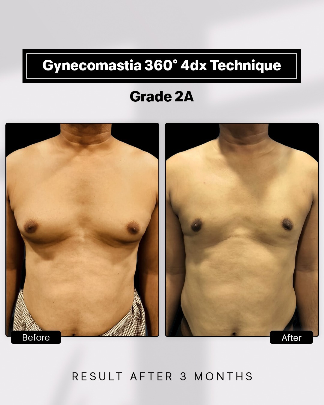 Before and After image for Gynecomastia Grade 2A