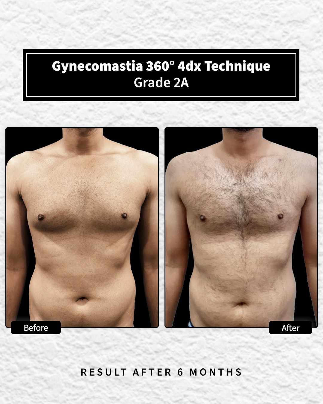 Before and After image for Gynecomastia Grade 2A