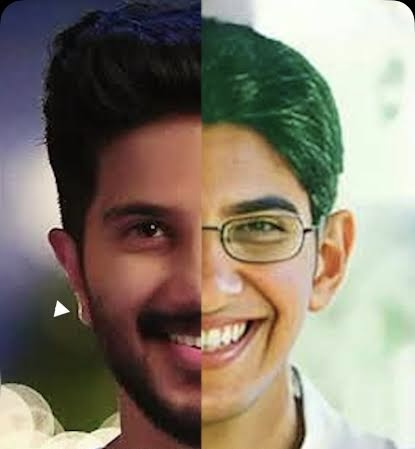 Dulquer Suleman post and pre ear pin back surgery photo