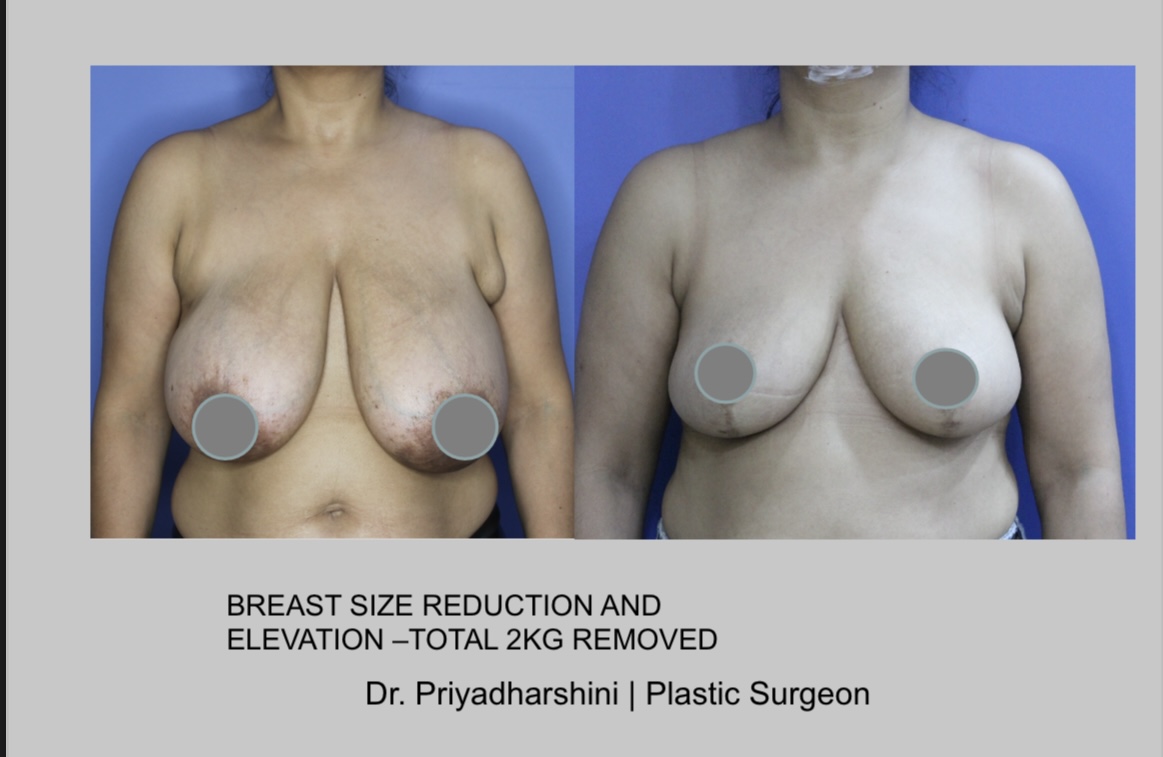 Pre and post breast reduction surgery showing the physical transformation and relief from the burden of large breasts
