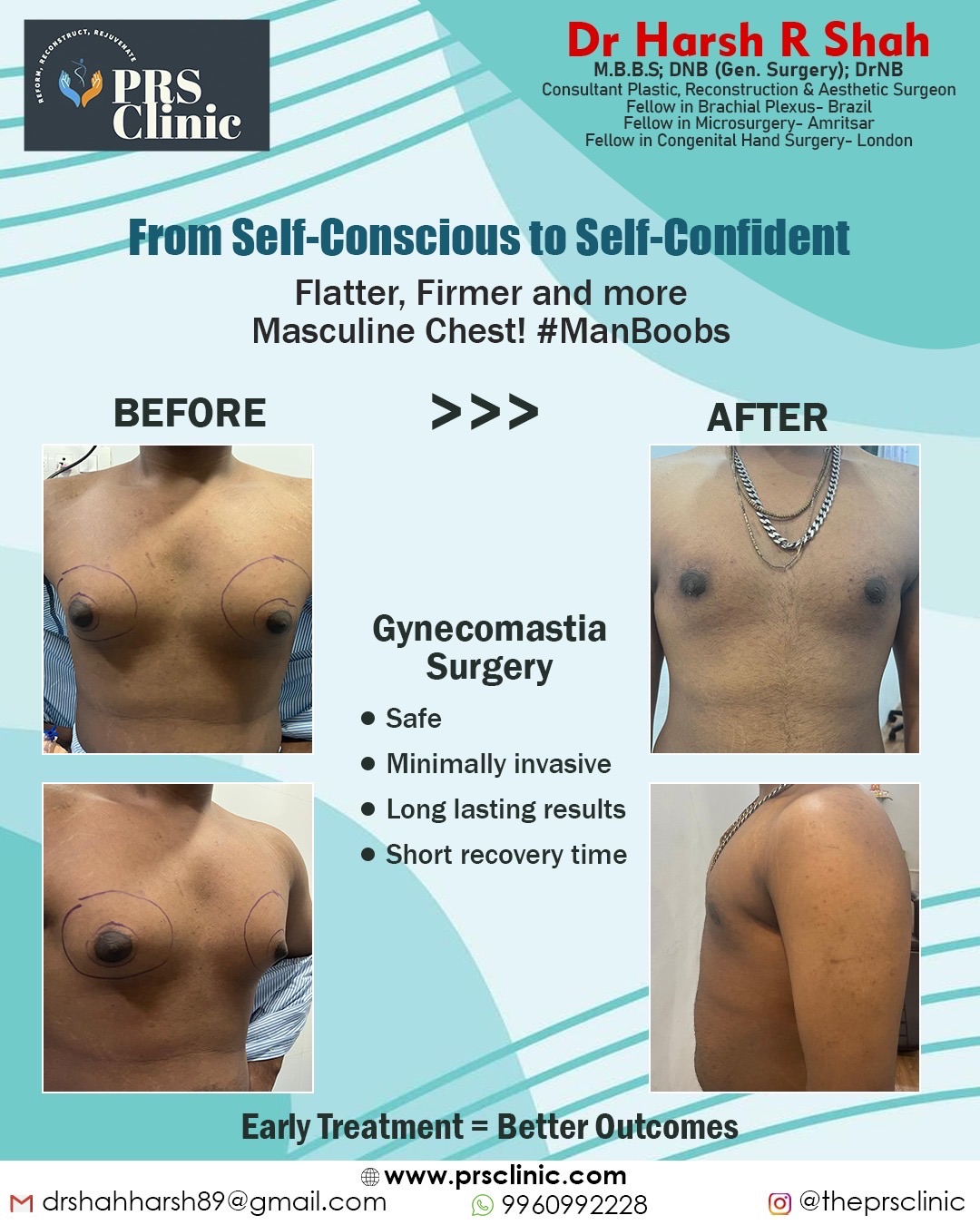 Before and After