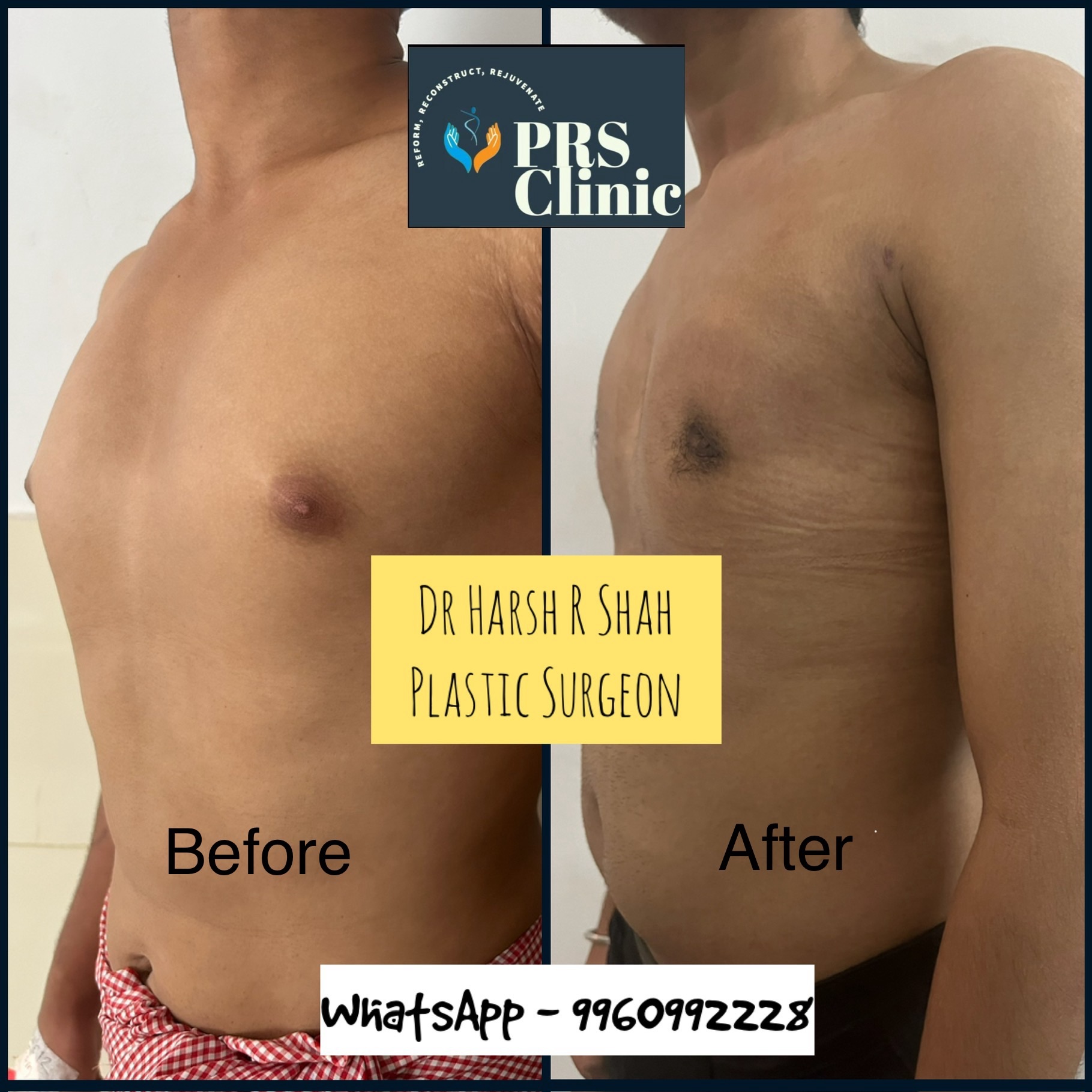 Before After images of a young male operated by Dr Harsh R Shah