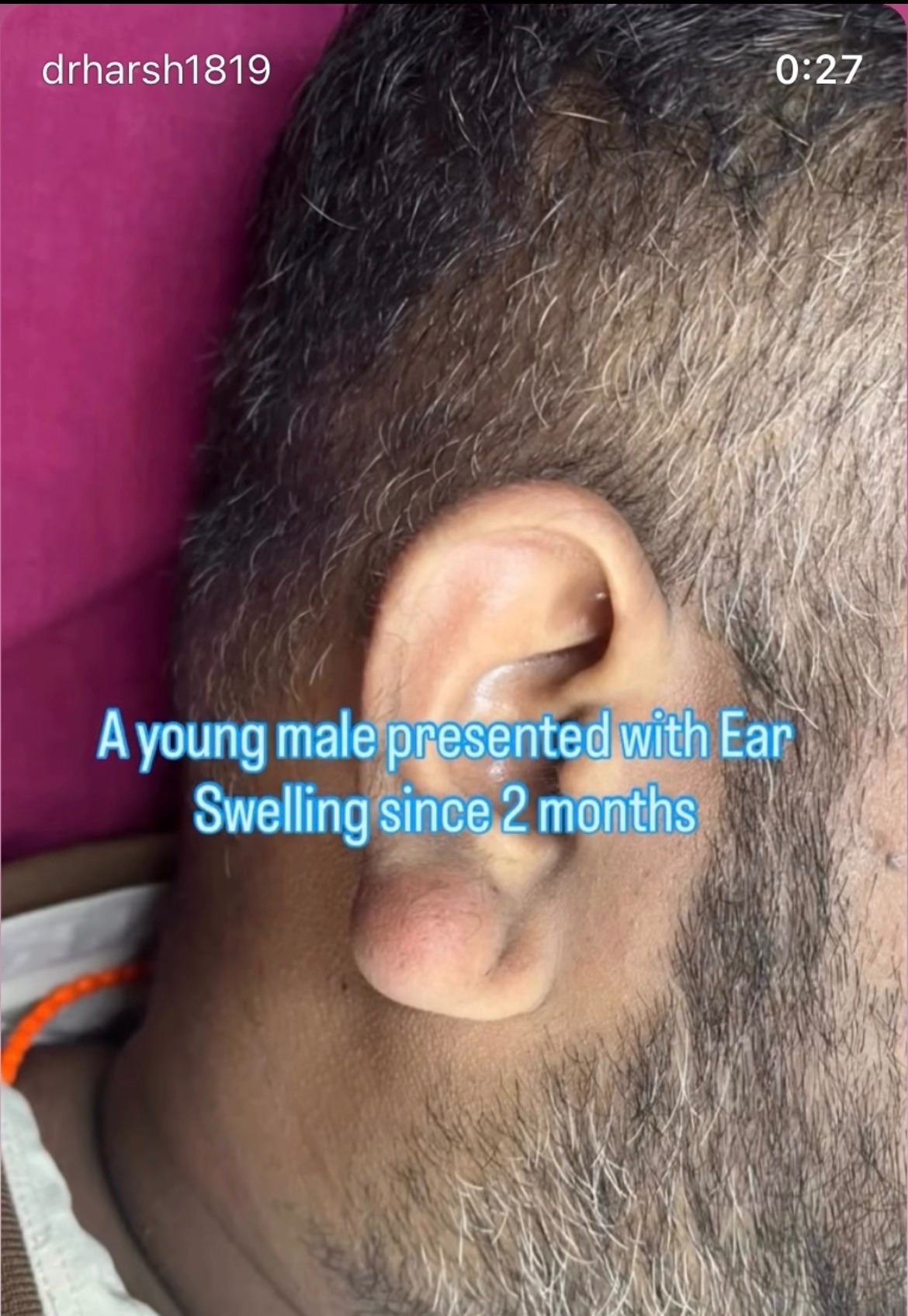 Ear cysts