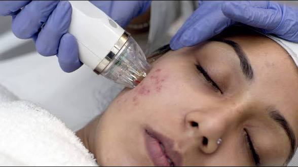 Micro needling/ MNRF