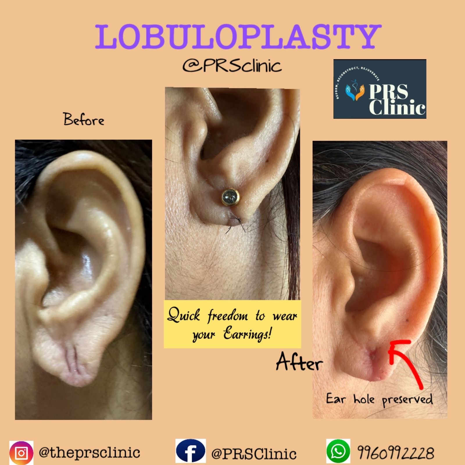 Before after image of technique done by Dr Harsh Shah