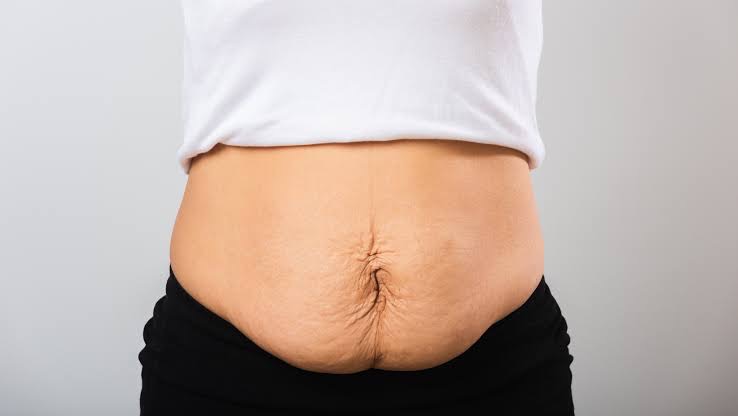 Mommy Belly Tummy Tuck