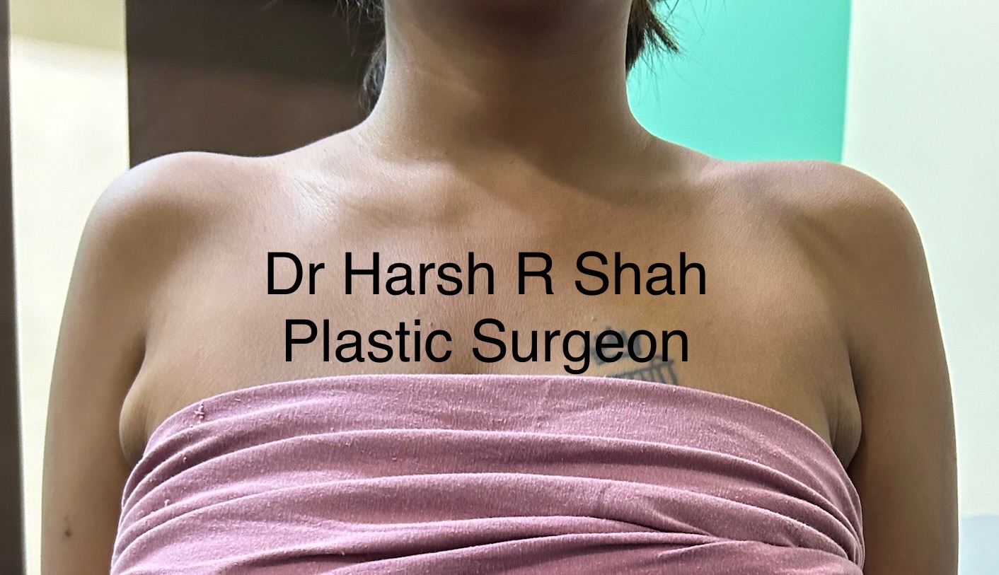 Mild grade of Axillary Breasts