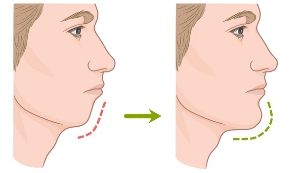 Chin Augmentation Surgery