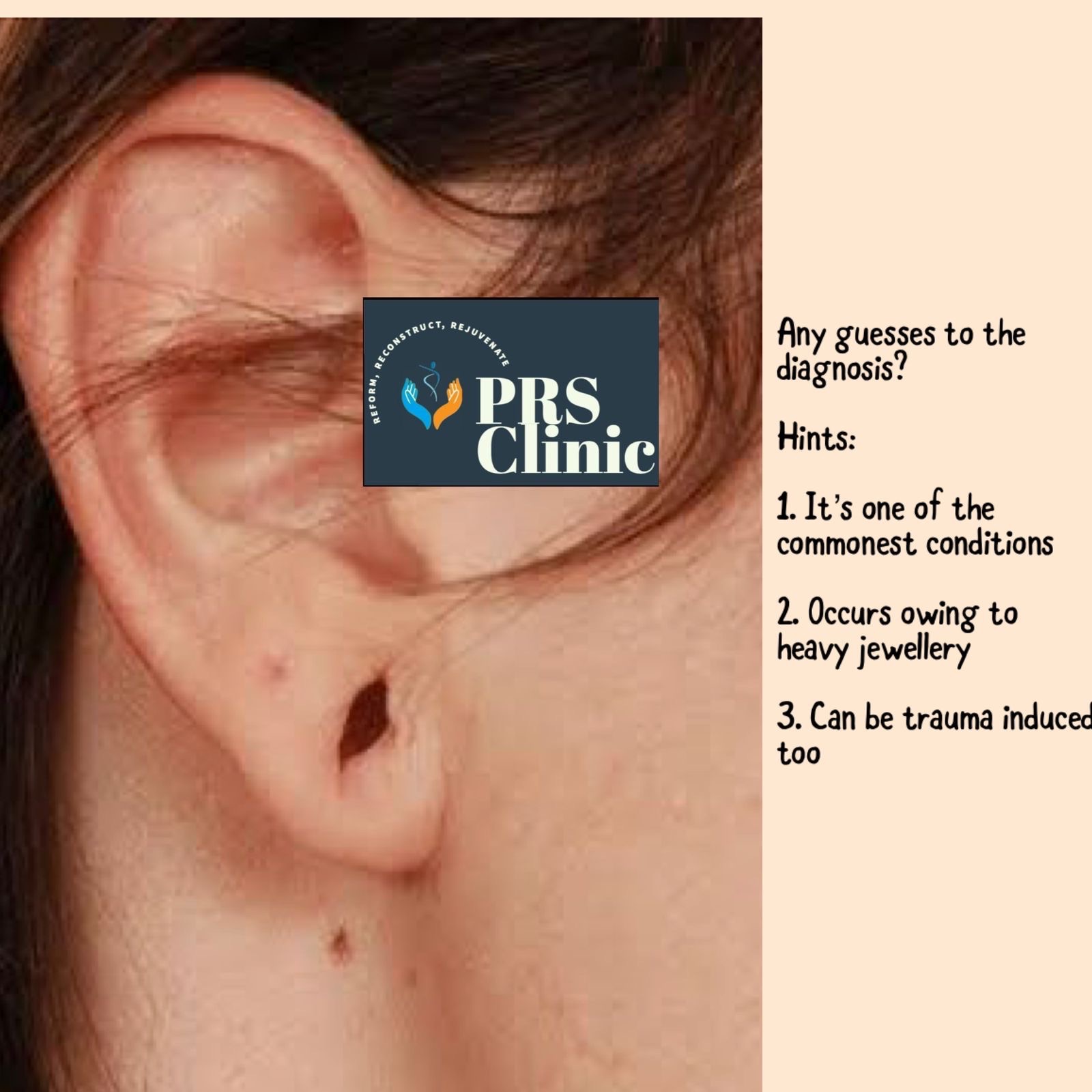 Ear Lobe Surgery Trends