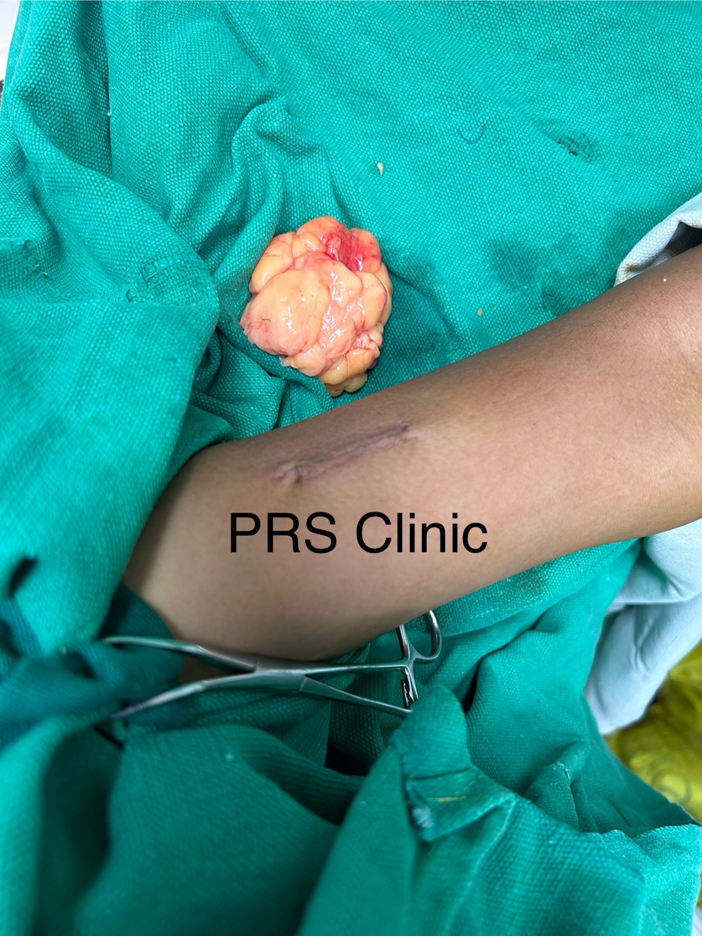 A case of multiple soft tissue swellings in a young male