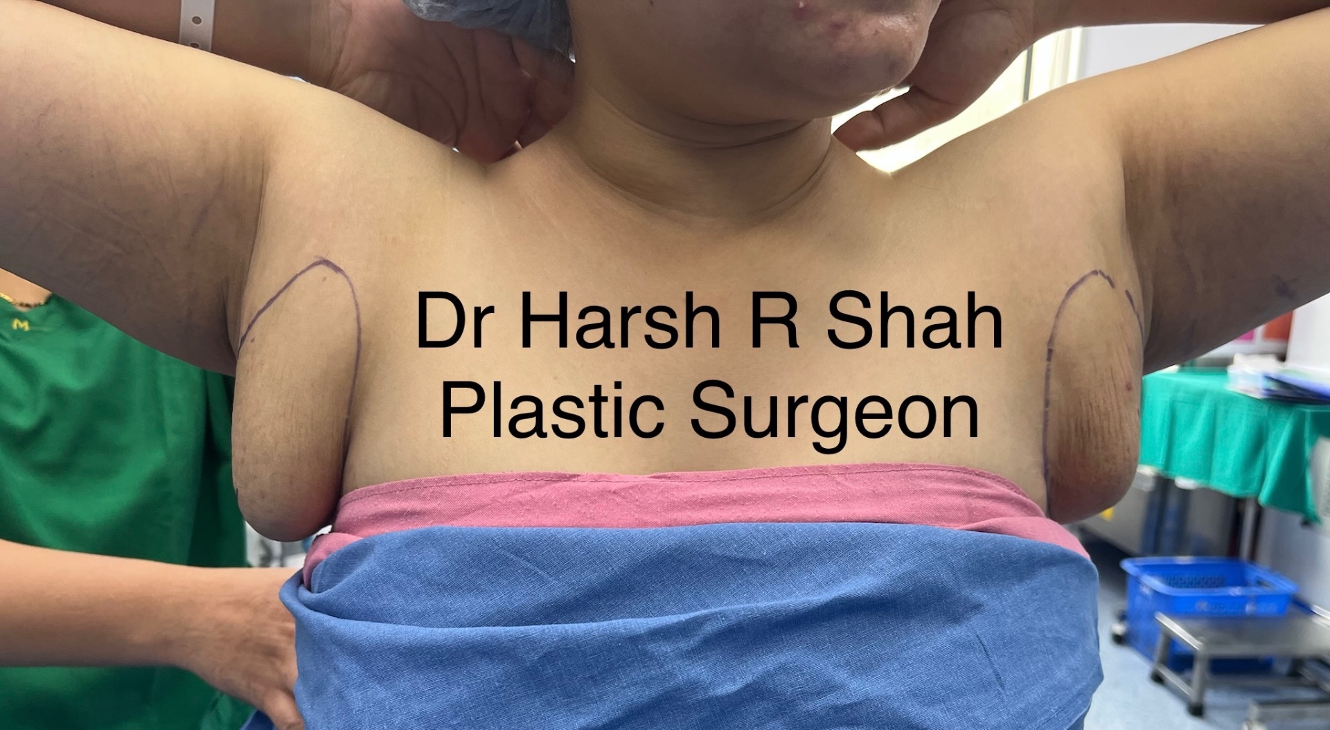 Severe grade of Axillary Breasts