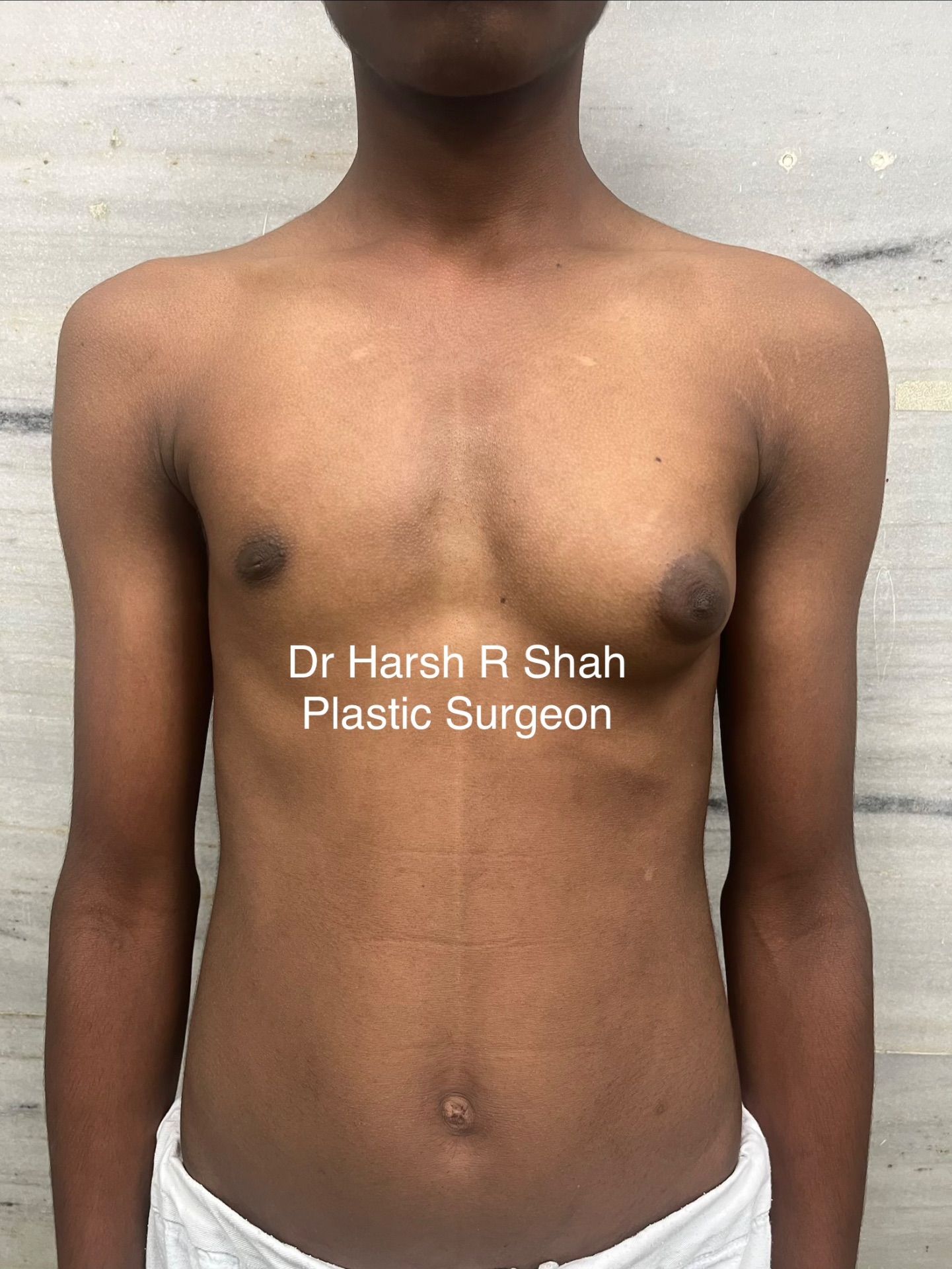 Case of unilateral Gynecomastia in a teenager