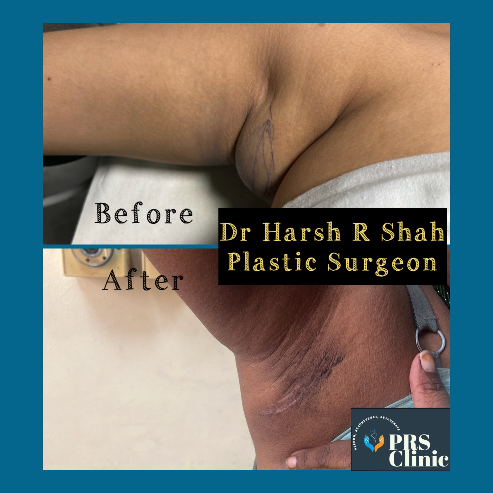 An example of case operated by Dr Harsh R Shah