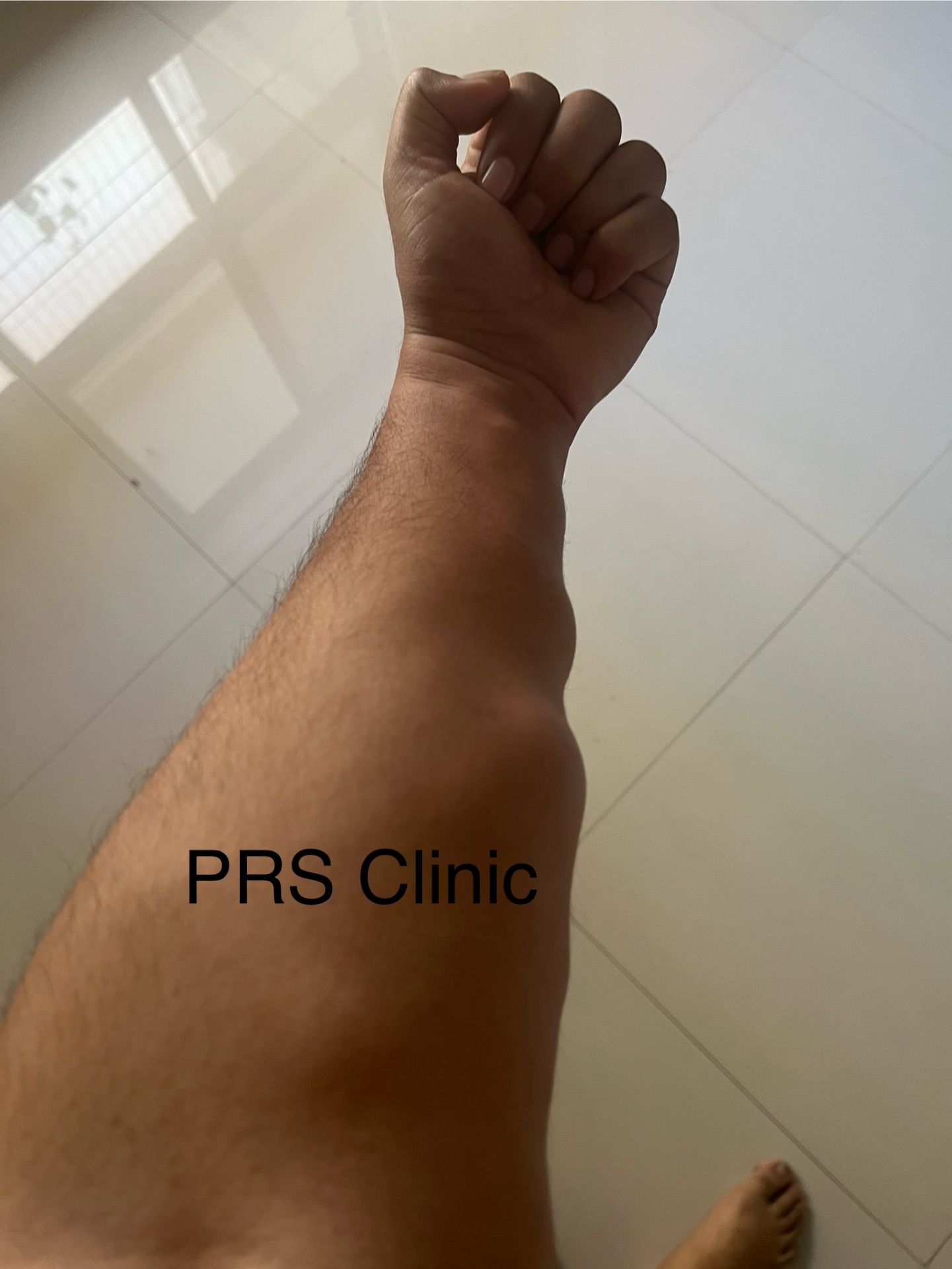 Large lipoma excised from arm