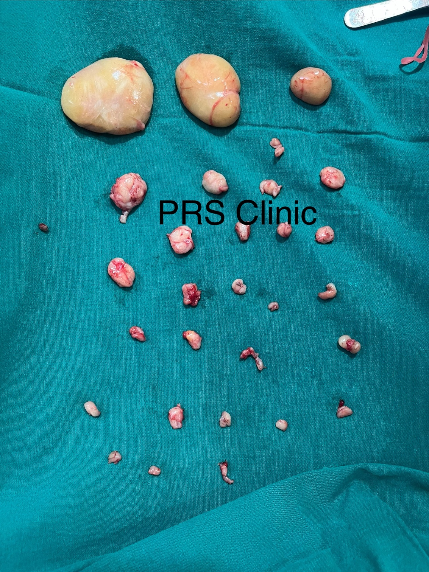 Case of total 28-30 lipomas excised from a person