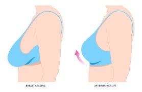 Breast changes following pregnancy (left) a lifted perkier breasts, post surgery (right side) 